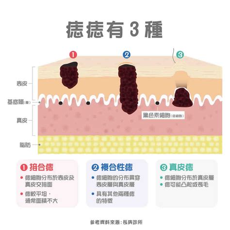 身體 痣|痣形成的原因？痣長毛、痣變多變大是痣病變？5招判。